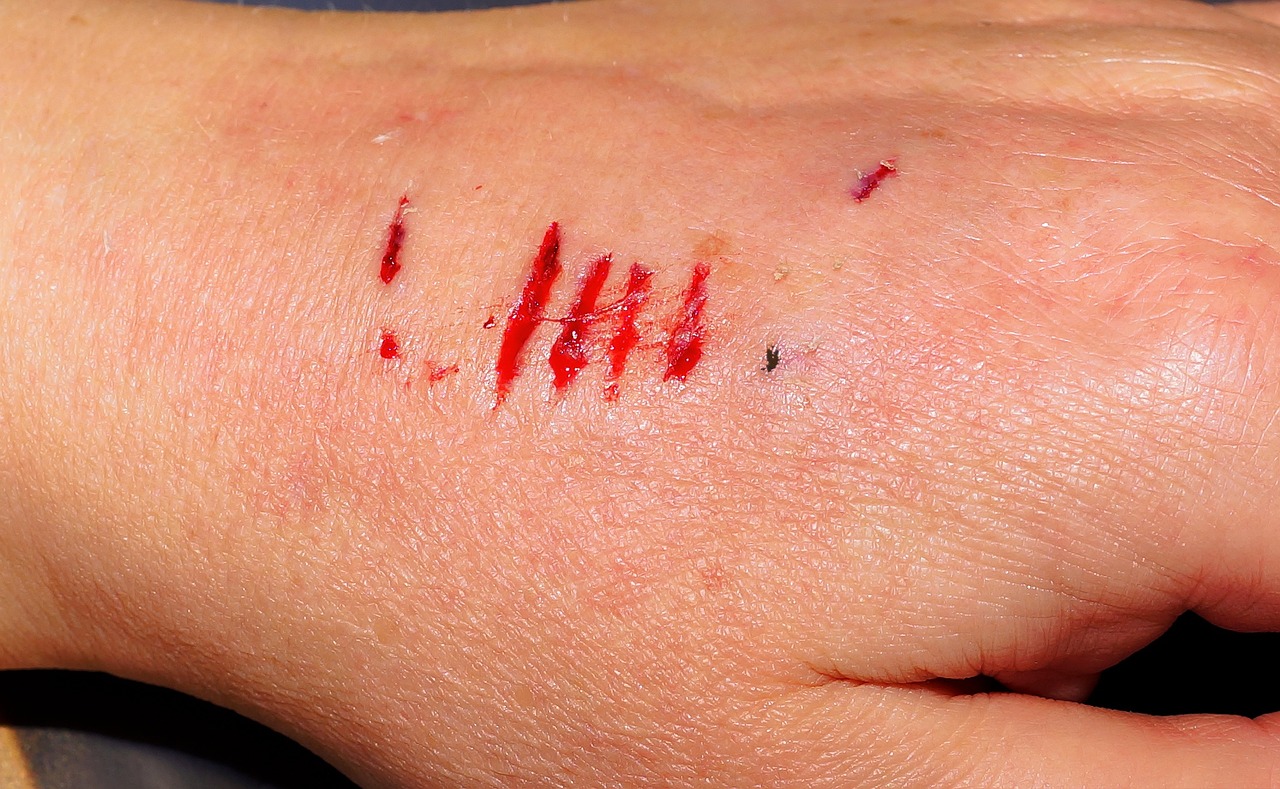 Can I Seek Compensation from the Owner of a Dog That Bit Me KM
